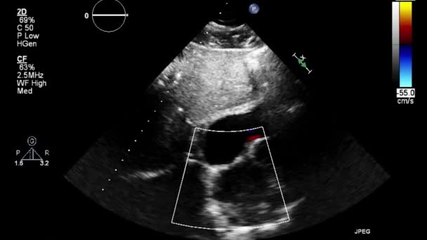 Ecografía Examen Transesofágico Del Corazón — Vídeos de Stock