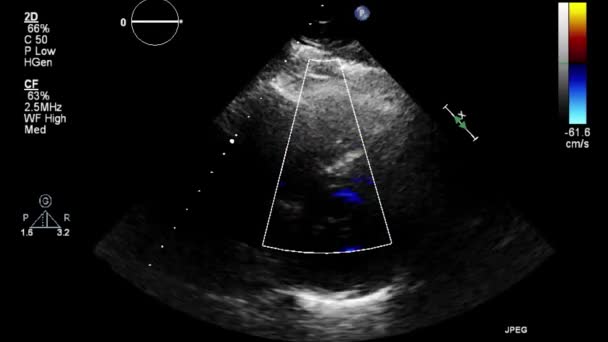 Echografie Transslokdarmonderzoek Van Het Hart — Stockvideo