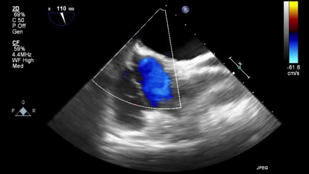 Ultrasound Transesophageal Examination Heart — Stock Video