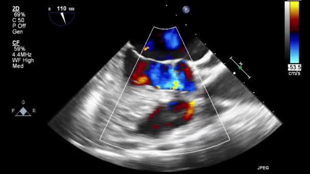 Echografie Transslokdarmonderzoek Van Het Hart — Stockvideo