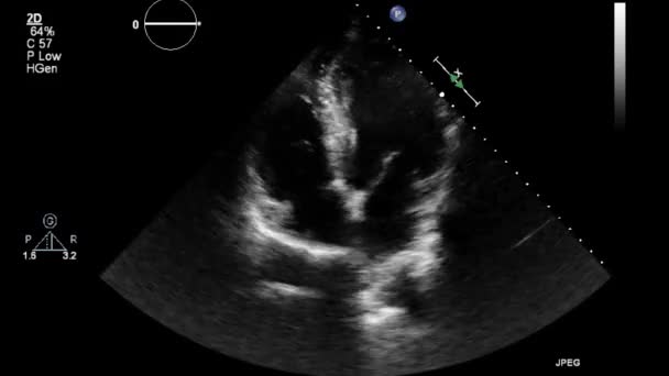 Ecografía Examen Transesofágico Del Corazón — Vídeo de stock