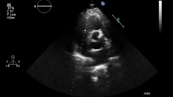 Exame Transesofágico Ultrassonográfico Coração — Vídeo de Stock