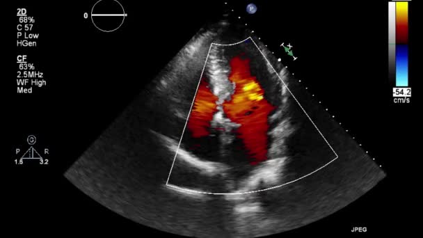 Ultrasound Transesophageal Examination Heart — Stock Video