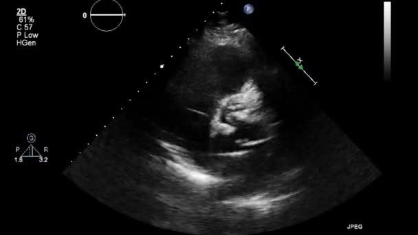 Exame Transesofágico Ultrassonográfico Coração — Vídeo de Stock