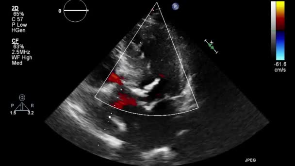 Echografie Transslokdarmonderzoek Van Het Hart — Stockvideo