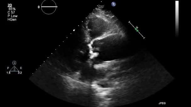 Exame Transesofágico Ultrassonográfico Coração — Vídeo de Stock