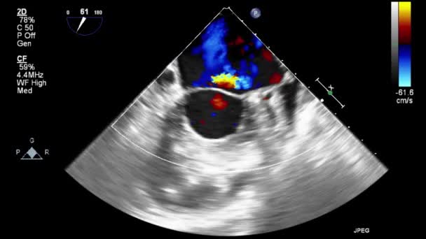 Echografie Transslokdarmonderzoek Van Het Hart — Stockvideo