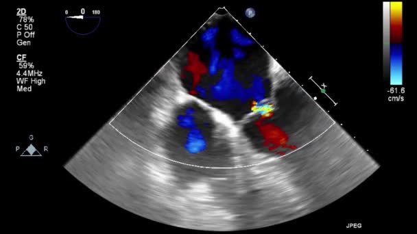 Ultrasound Transesophageal Examination Heart — Stock Video