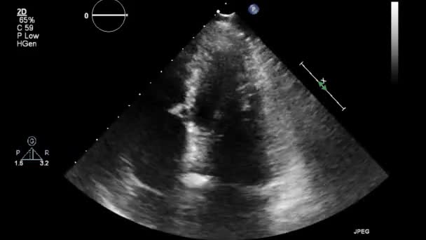Ecografía Examen Transesofágico Del Corazón — Vídeo de stock