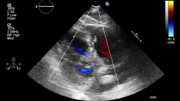 Ultrasound Transesophageal Examination Heart — Stock Video