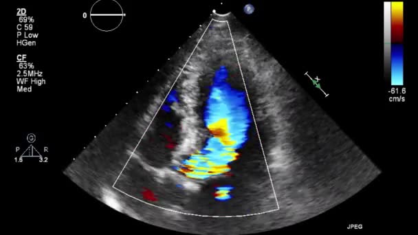 Ecografia Esame Transesofageo Del Cuore — Video Stock