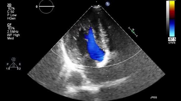 Kalbin Ultrason Transsofageal Muayenesi — Stok video