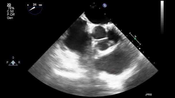 Echografie Transslokdarmonderzoek Van Het Hart — Stockvideo