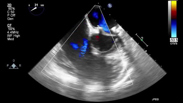 Ecografia Esame Transesofageo Del Cuore — Video Stock