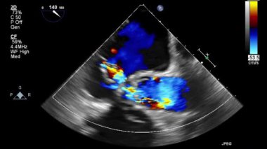 Kalbin ultrason transsofageal muayenesi.