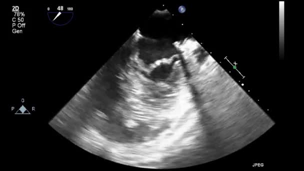 Echografie Transslokdarmonderzoek Van Het Hart — Stockvideo