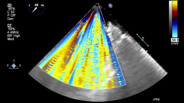 Kalbin Ultrason Transsofageal Muayenesi — Stok video