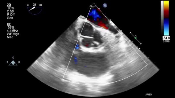 Echografie Transslokdarmonderzoek Van Het Hart — Stockvideo