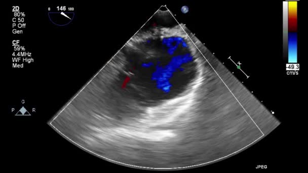 Ecografia Esame Transesofageo Del Cuore — Video Stock