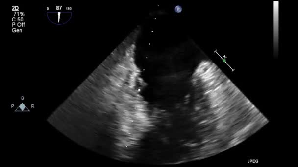 Ultrasound Transesophageal Examination Heart — Stock Video