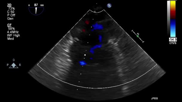 Ultrasound Transesophageal Examination Heart — Stock Video