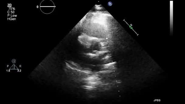초음파 식도를 — 비디오