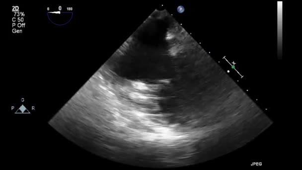 Ultraschall Transesophageale Untersuchung Des Herzens — Stockvideo