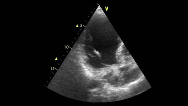 Kalbin Ultrason Transsofageal Muayenesi — Stok video