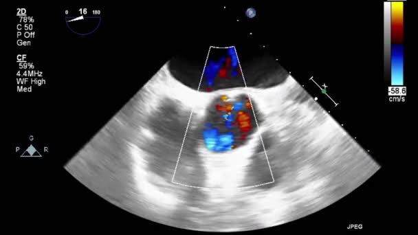 Ultraschall Transesophageale Untersuchung Des Herzens — Stockvideo