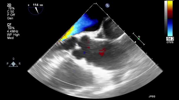 Ультразвуковое Трансофагеальное Исследование Сердца — стоковое видео