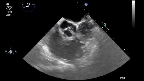 Ultraljudstransesofageal Undersökning Hjärtat — Stockvideo