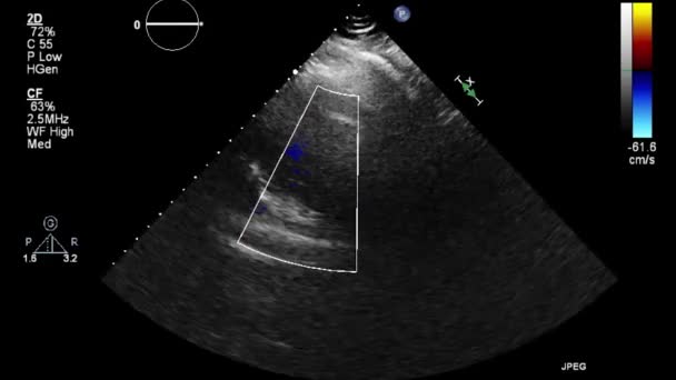 Echografie Transslokdarmonderzoek Van Het Hart — Stockvideo