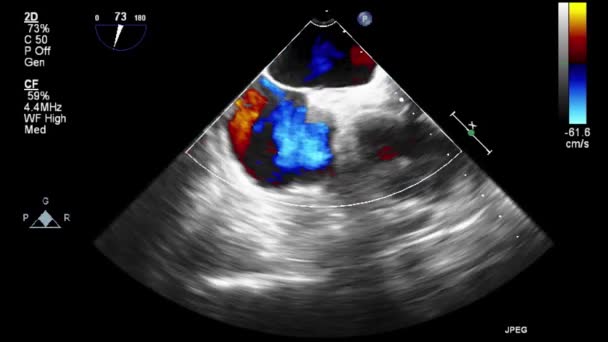 Exame Transesofágico Ultrassonográfico Coração — Vídeo de Stock
