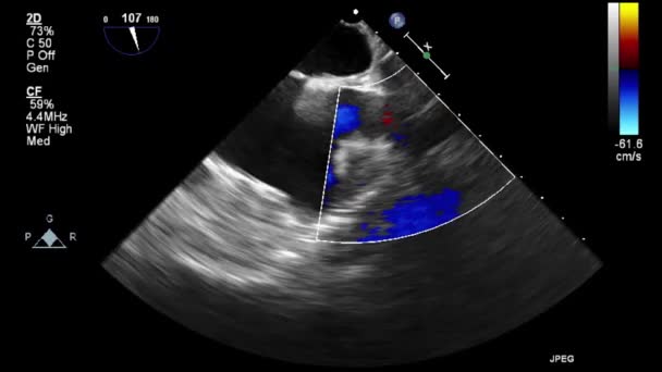 Exame Transesofágico Ultrassonográfico Coração — Vídeo de Stock
