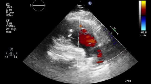 Ecografía Examen Transesofágico Del Corazón — Vídeos de Stock