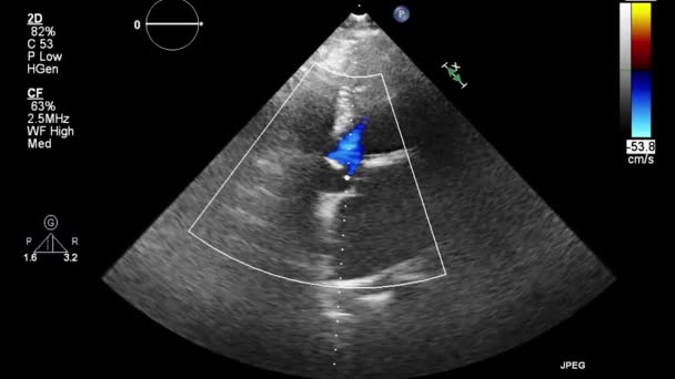 Ecografia Esame Transesofageo Del Cuore — Video Stock