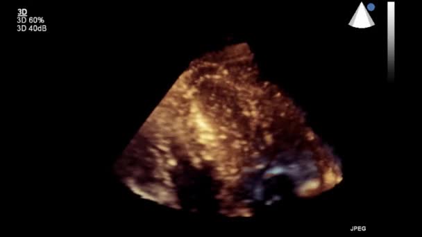 Ultrasound Transesophageal Examination Heart — Stock Video