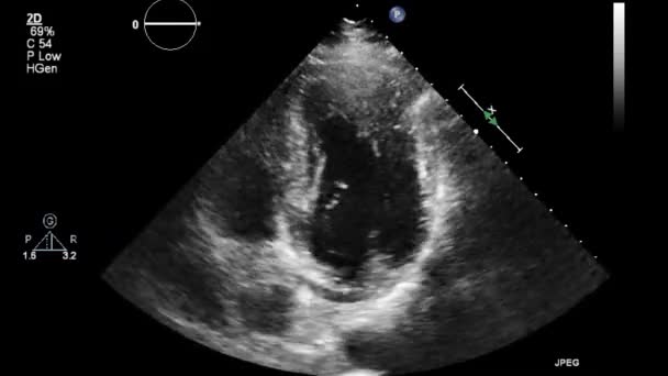 Kalbin Ultrason Transsofageal Muayenesi — Stok video