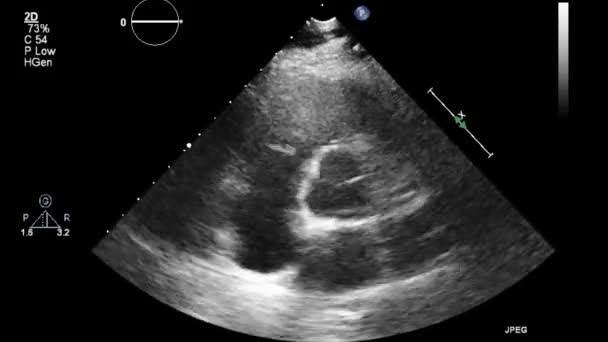 Ecografía Examen Transesofágico Del Corazón — Vídeos de Stock