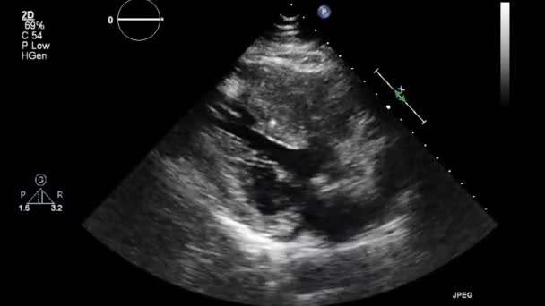 Ultraljudstransesofageal Undersökning Hjärtat — Stockvideo