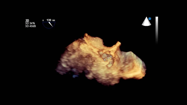 Obraz Srdce Během Transesophageální Ultrazvuk Srdce — Stock fotografie