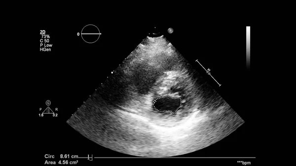 Image Heart Gray Scale Mode Transesophageal Ultrasound — Stock Photo, Image