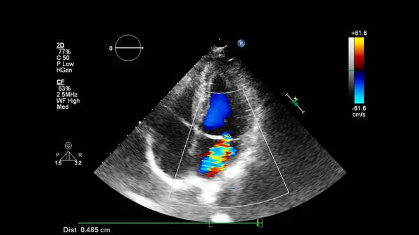 Imagen Del Corazón Durante Ecografía Transesofágica Con Modo Doppler — Foto de Stock