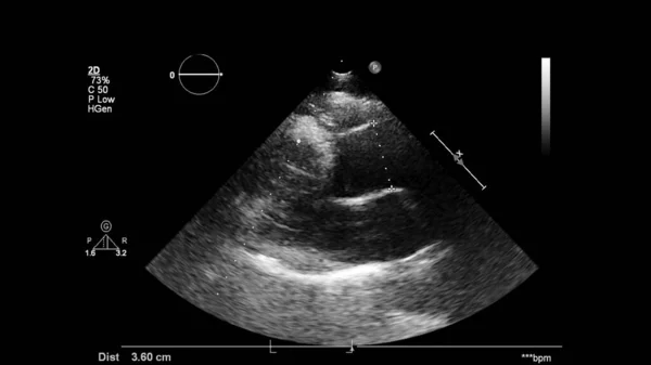 Transesofageal Ultrason Sırasında Kalbin Gri Ölçekli Görüntüsü — Stok fotoğraf