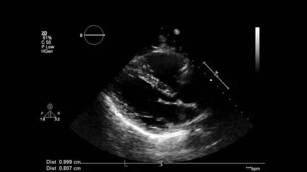 Transesofageal Ultrason Sırasında Kalbin Gri Ölçekli Görüntüsü — Stok fotoğraf