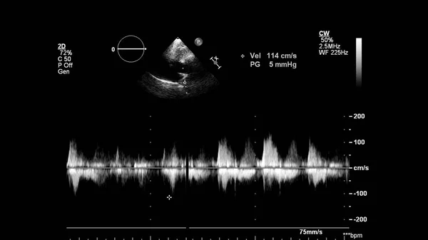 Image Heart Gray Scale Mode Transesophageal Ultrasound — Stock Photo, Image