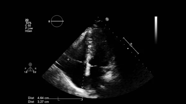 Transesofageal Ultrason Sırasında Kalbin Gri Ölçekli Görüntüsü — Stok fotoğraf