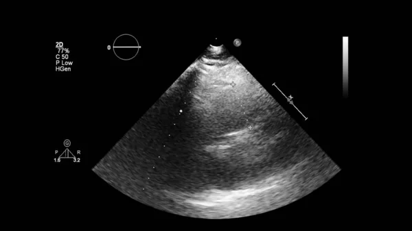 Transesofageal Ultrason Sırasında Kalbin Gri Ölçekli Görüntüsü — Stok fotoğraf