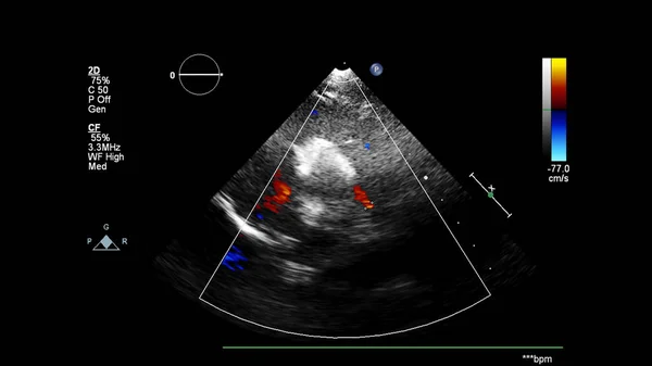 Imagem Coração Durante Ultrassom Transesofágico Com Modo Doppler — Fotografia de Stock