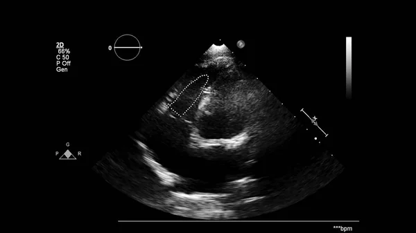 Abbildung Des Herzens Graustufen Modus Während Des Transesophagealen Ultraschalls — Stockfoto